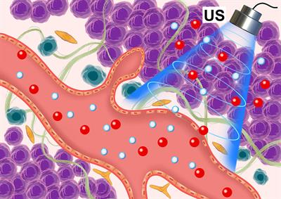 Microbubbles Ultrasonic Cavitation Regulates Tumor Interstitial Fluid Pressure and Enhances Sonodynamic Therapy